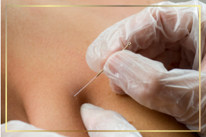 Dry needling for chronic shoulder, neck pain