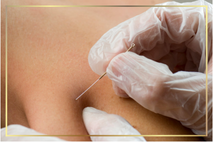 Dry needling for chronic shoulder, neck pain